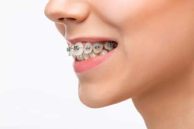 Overbite, Underbite, or Crossbite